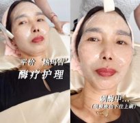 「欧蒂莲刷酶」俗称热玛吉的刷酶是什么神仙操作?一次就看得见提拉逆龄效果